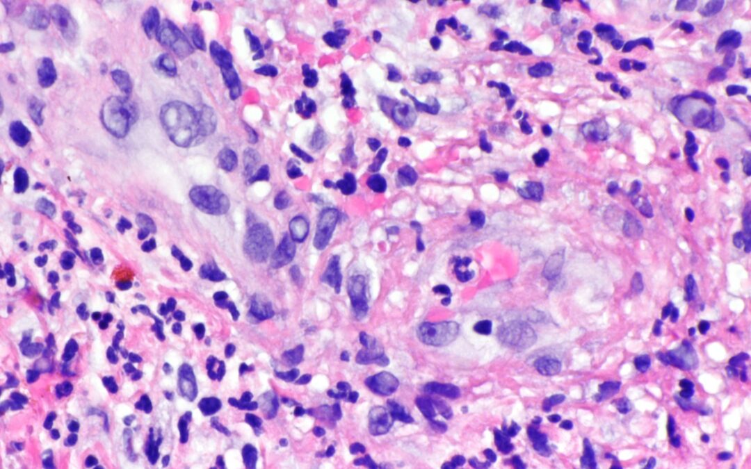 Células afectadas por vasculitis linfocítica./ Wikimedia.
